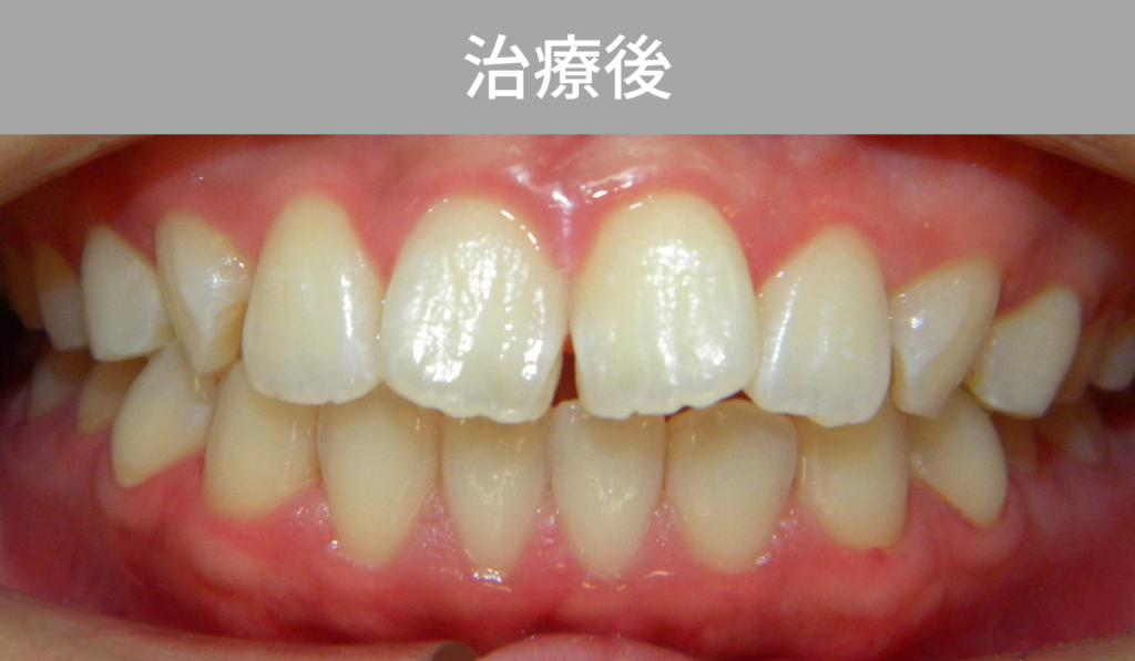 ホームホワイトニング症例（治療後）