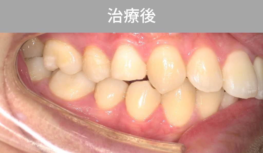ガムブリーチング　治療後